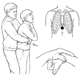 Clip bác sĩ dùng động tác Heimlich cứu mạng em bé khiến dân thán phục  第1张